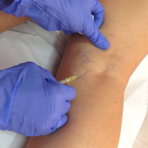 Esclerosis de Varices