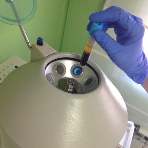 Plasma Rico en Plaquetas