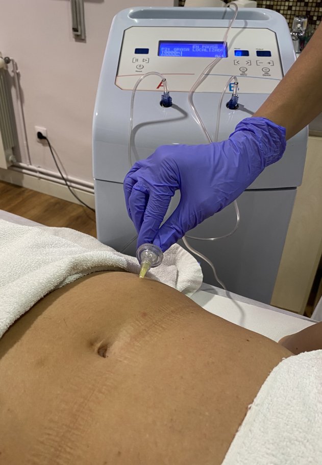 Carboxiterapia