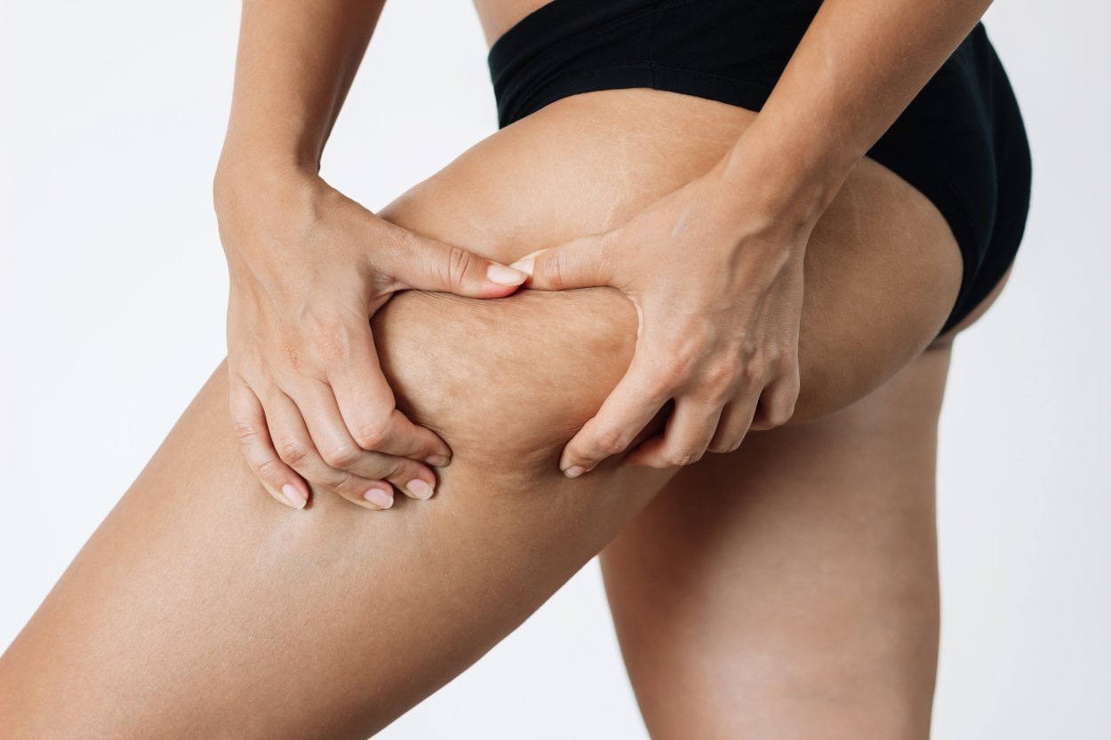 Presoterapia-Celulitis